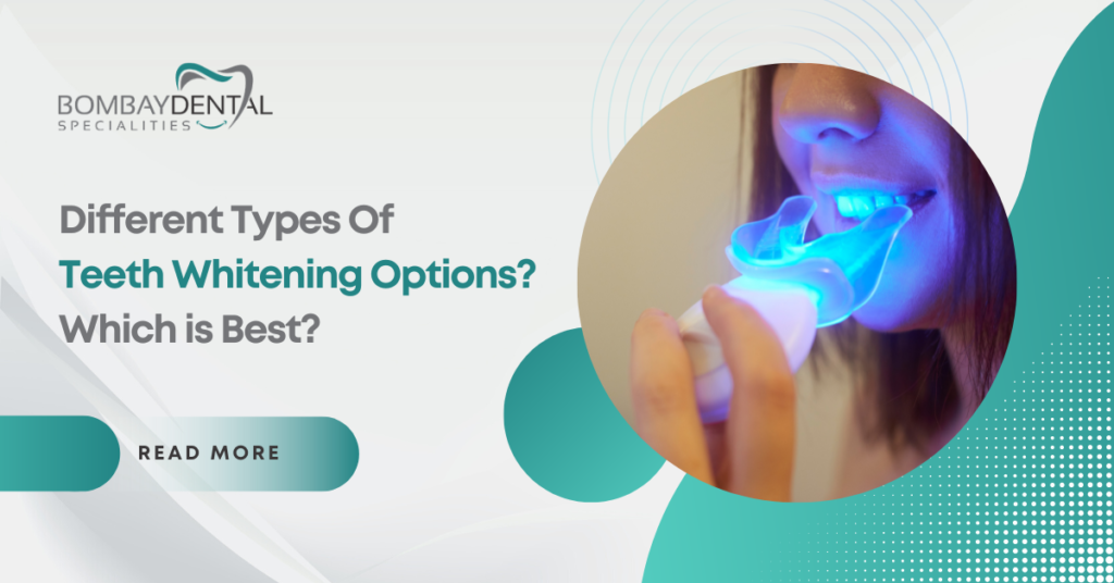 Teeth Whitening Options: Which One is Best for You
