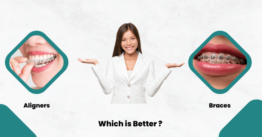 Aligners vs. Braces – Which is Better