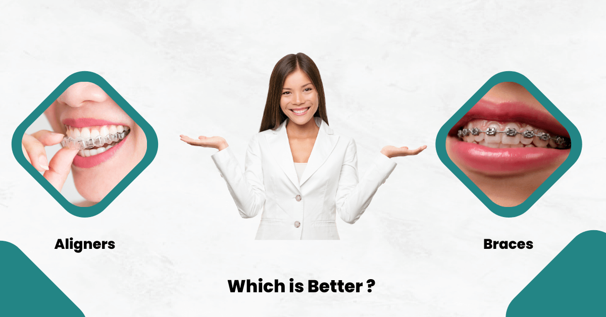 Aligners vs. Braces – Which is Better?