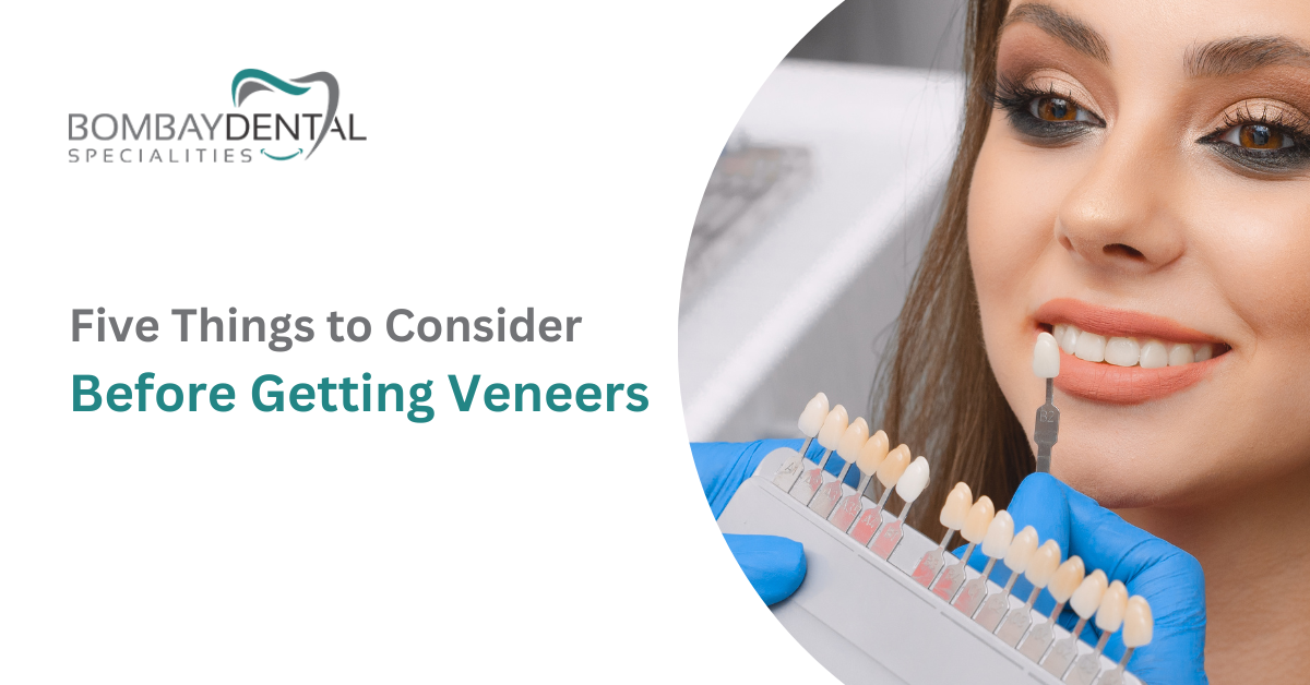 Five Things to Consider Before Getting Veneers