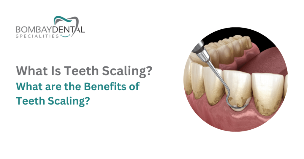 What Is Teeth Scaling? What are the Benefits of Teeth Scaling?