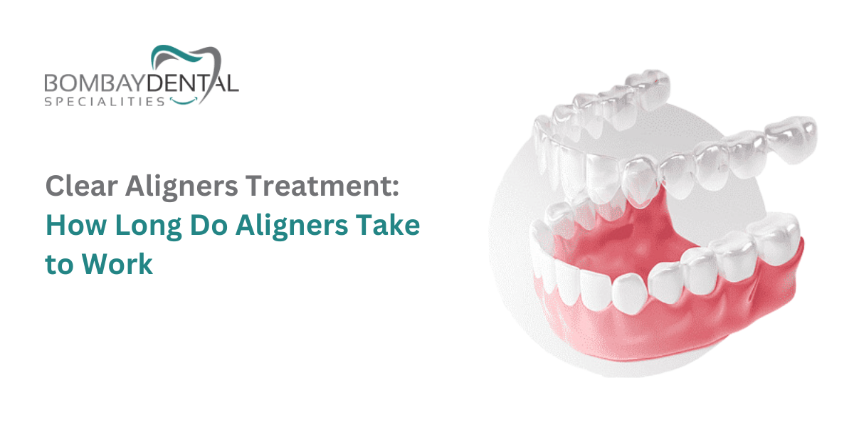 How Long Does It Take Clear Aligners to Work?