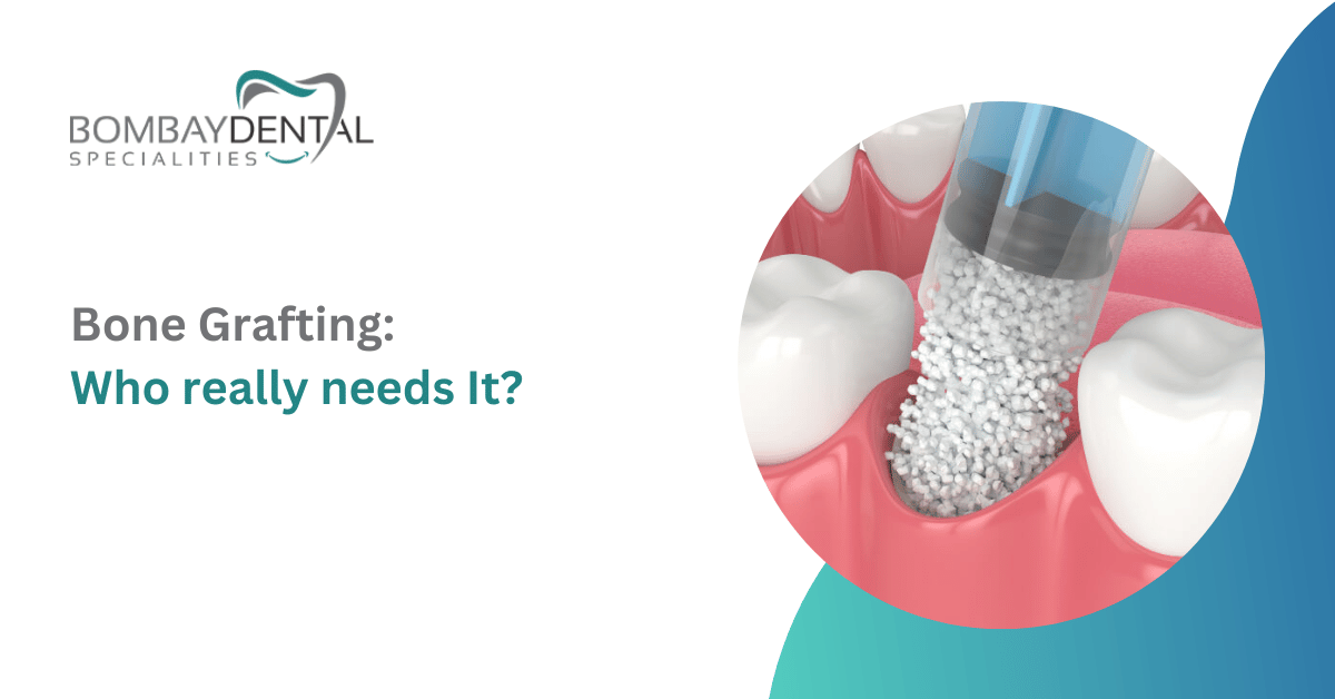 Bone Grafting: Who Really Needs It?