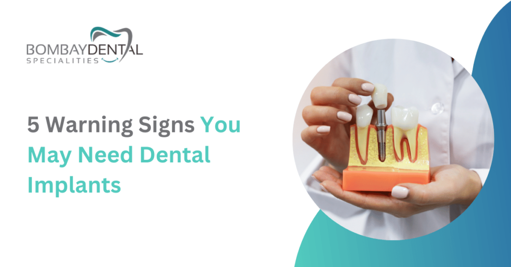 5 Warning Signs You May Need Dental Implants