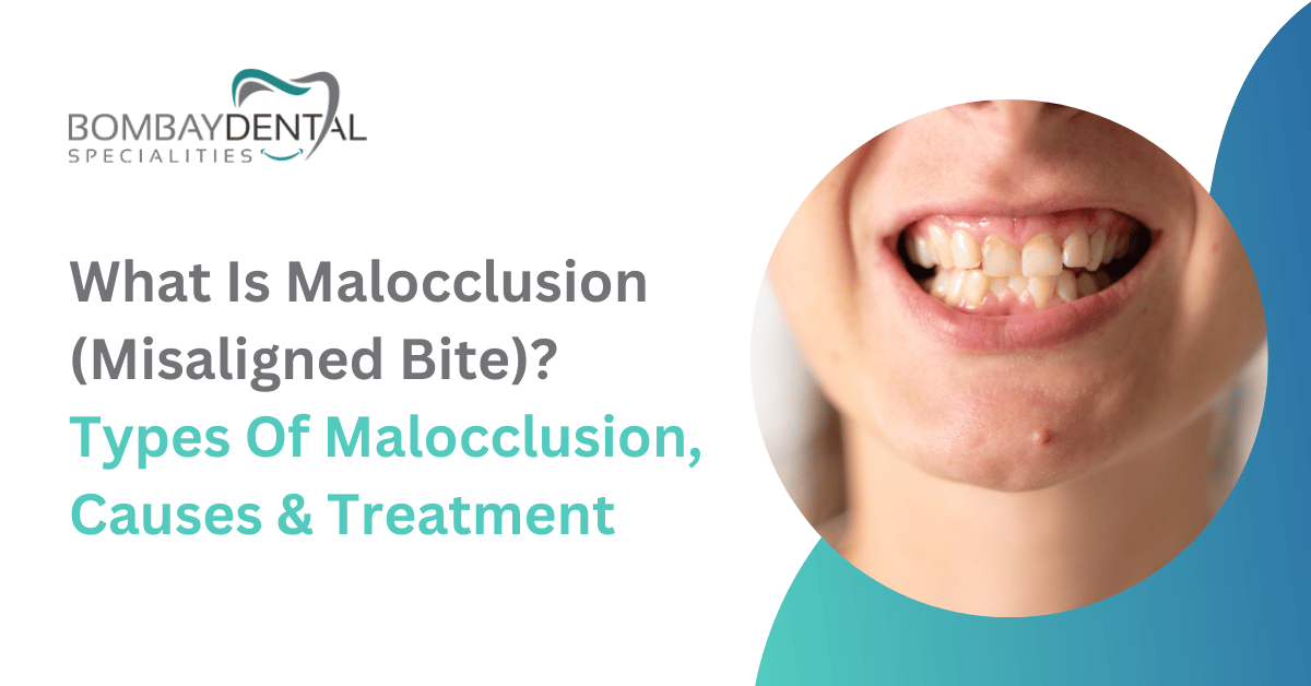 What Is Malocclusion (Misaligned Bite)? Types Of Malocclusion, Causes & Treatment