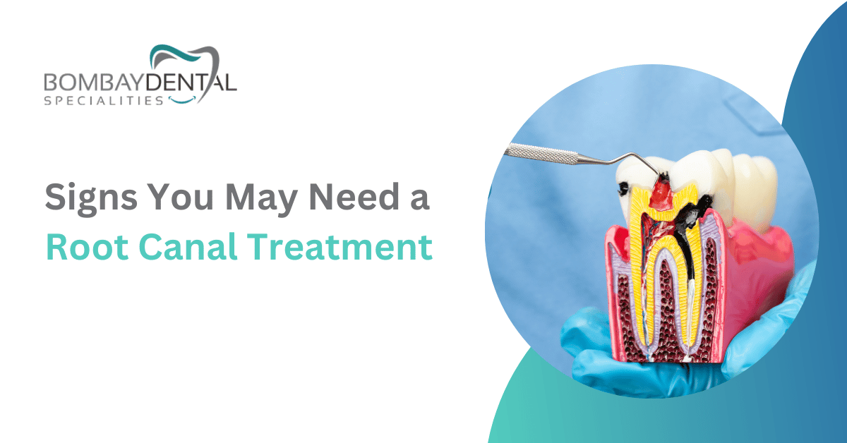 Signs You May Need a Root Canal Treatment