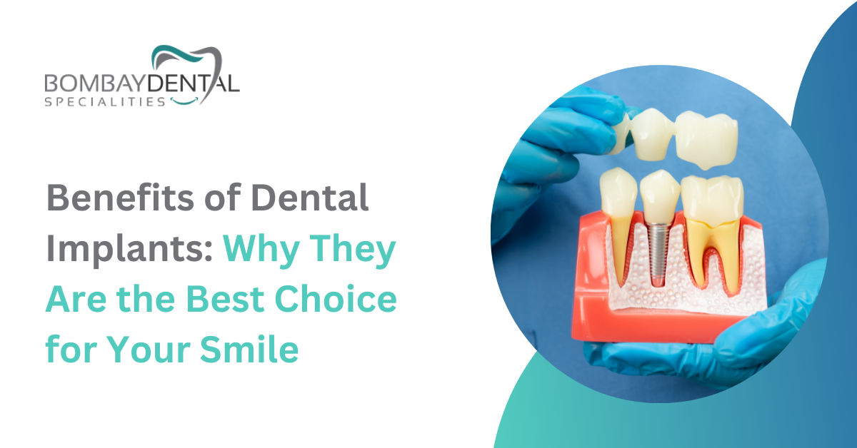 Benefits of Dental Implants: Why They Are the Best Choice for Your Smile