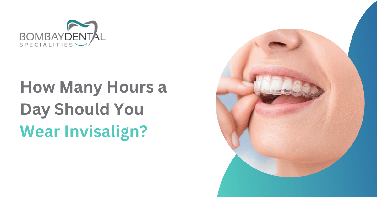 How Many Hours a Day Should You Wear Invisalign?